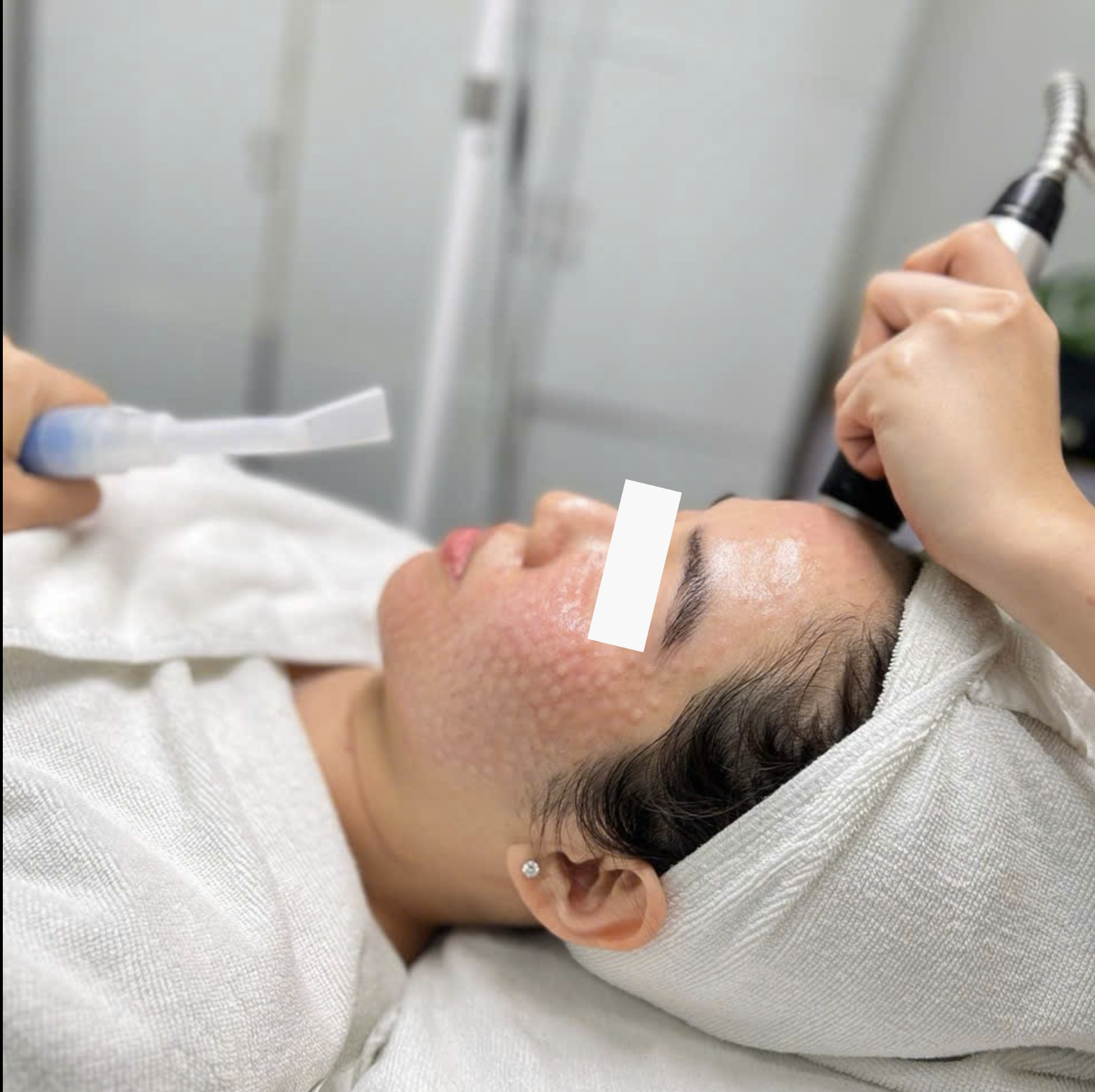 Với công nghệ tiêm meso trị mụn hiện đại, tiêm meso trị mụn là gì và tiêm meso trị mụn giá bao nhiêu trở thành tiêu chí đánh giá tiện ích cùng với các loại meso trị mụn được áp dụng trong điều trị.