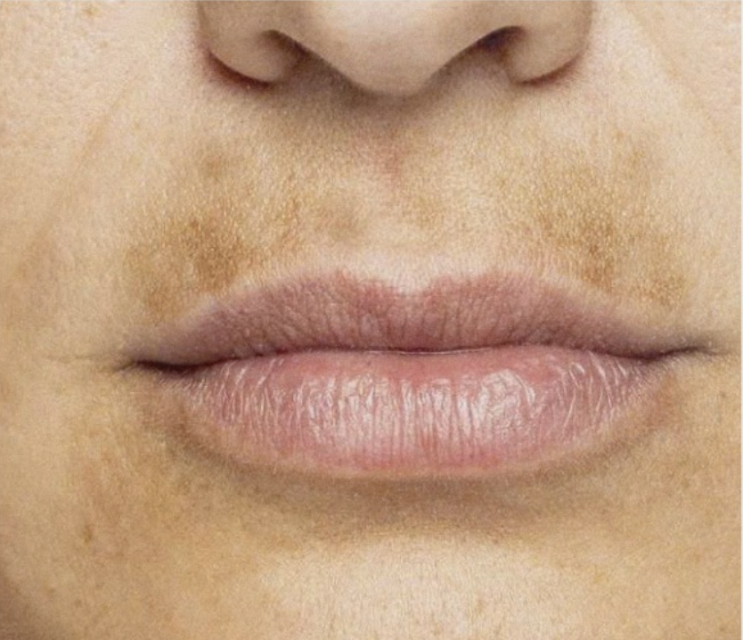 Hiệu quả điều trị nám sau sinh tại lona skin lab được thể hiện qua từng bước chăm sóc da, từ phục hồi sau khi sinh con đến điều trị nám nội tiết, mang lại làn da sáng mịn và đều màu nhờ quy trình điều trị nám chuyên nghiệp.