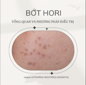 Điều trị bớt Hori tại Lona Skin Lab