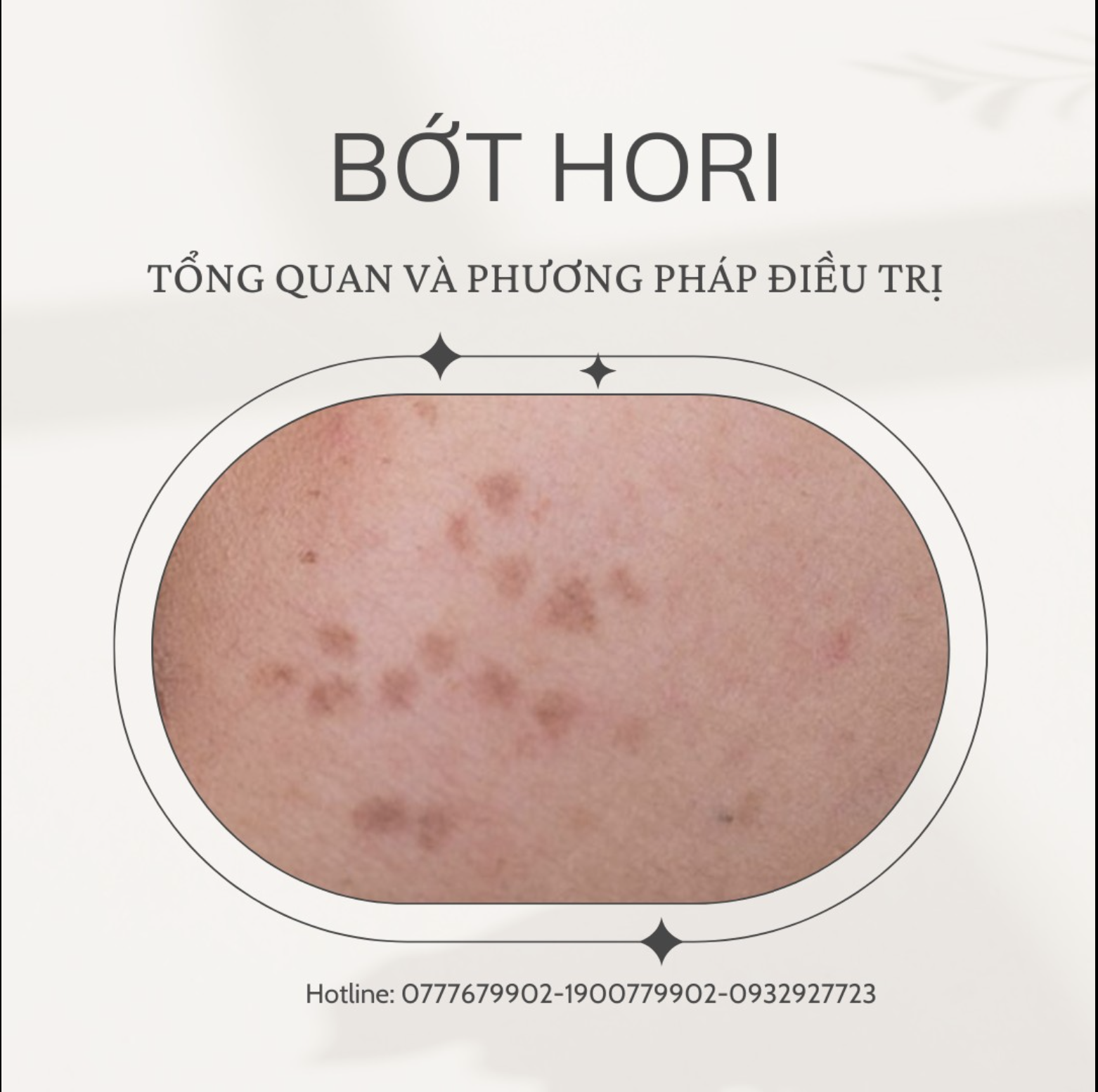 Hình ảnh kỹ thuật laser tiên tiến điều trị bớt hori, cho phép phân biệt bớt Hori và nám da thông qua việc nhận diện các triệu chứng bớt Hori và tàn nhang kèm theo.