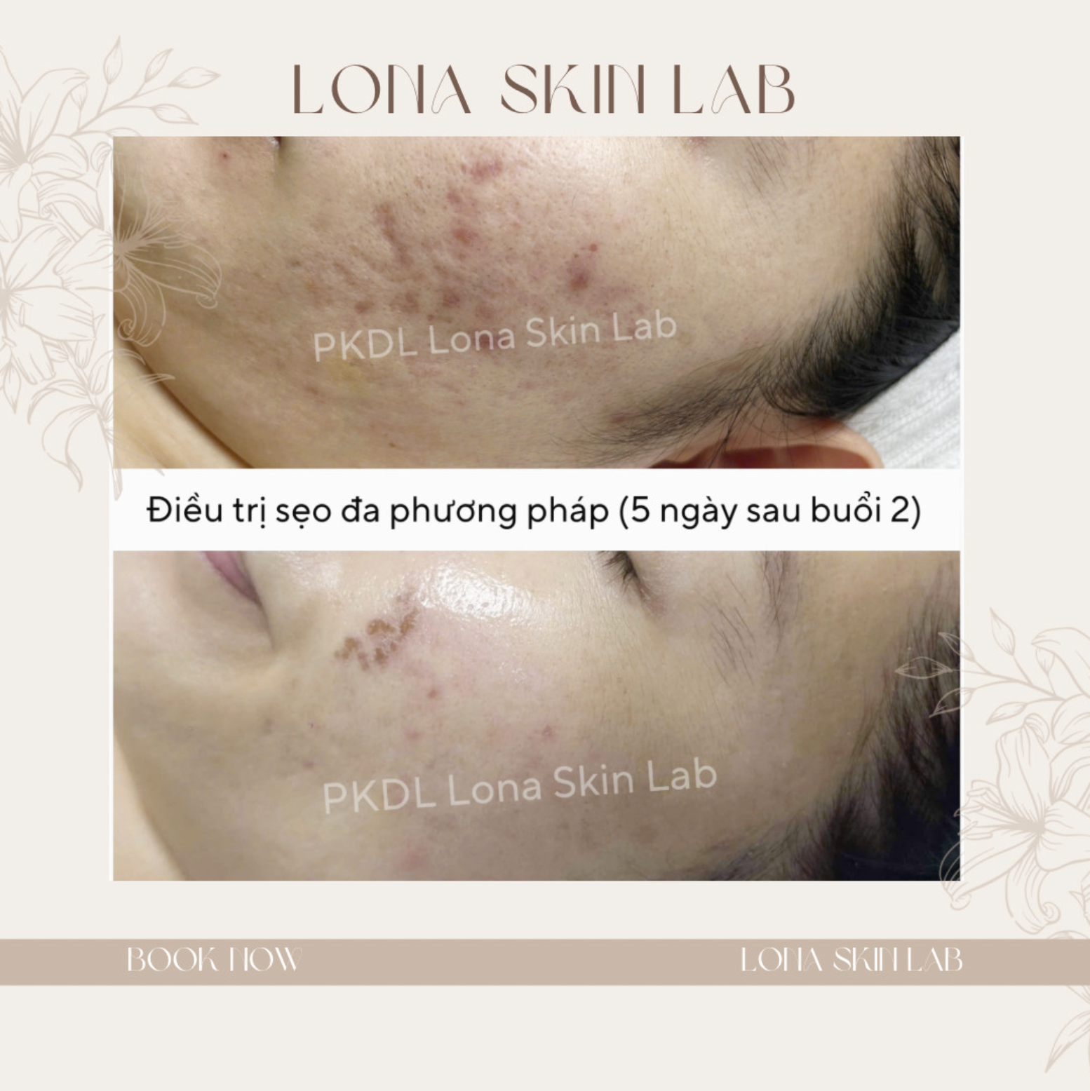 Quy trình tiêm meso căng bóng tiên tiến thể hiện hiệu quả tiêm meso vượt trội, lợi ích tiêm meso được chứng minh qua việc tiêm mesotherapy hiện đại, góp phần trẻ hóa da bằng meso một cách tự nhiên và an toàn.