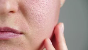 Phân biệt sẹo đáy nhọn qua các hình dạng