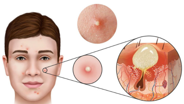 Mục trứng cá nguyên nhân gây ra sẹo đáy nhọn