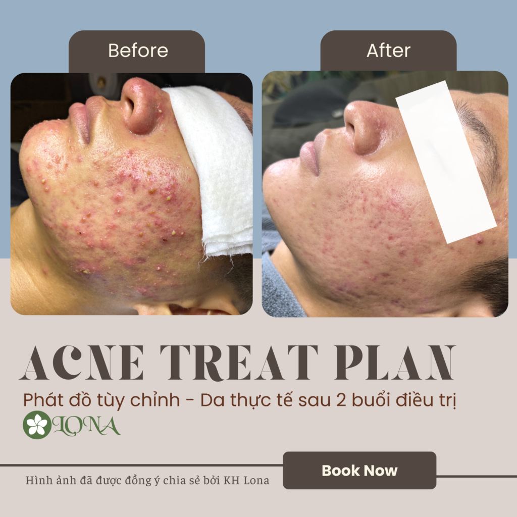 Quá trình chăm sóc da tuổi dậy thì đòi hỏi sự kết hợp giữa điều trị mụn tuổi dậy thì và hướng dẫn skincare cho trẻ, góp phần cải thiện tâm lý tuổi dậy thì khi bước vào tuổi dậy thì.
