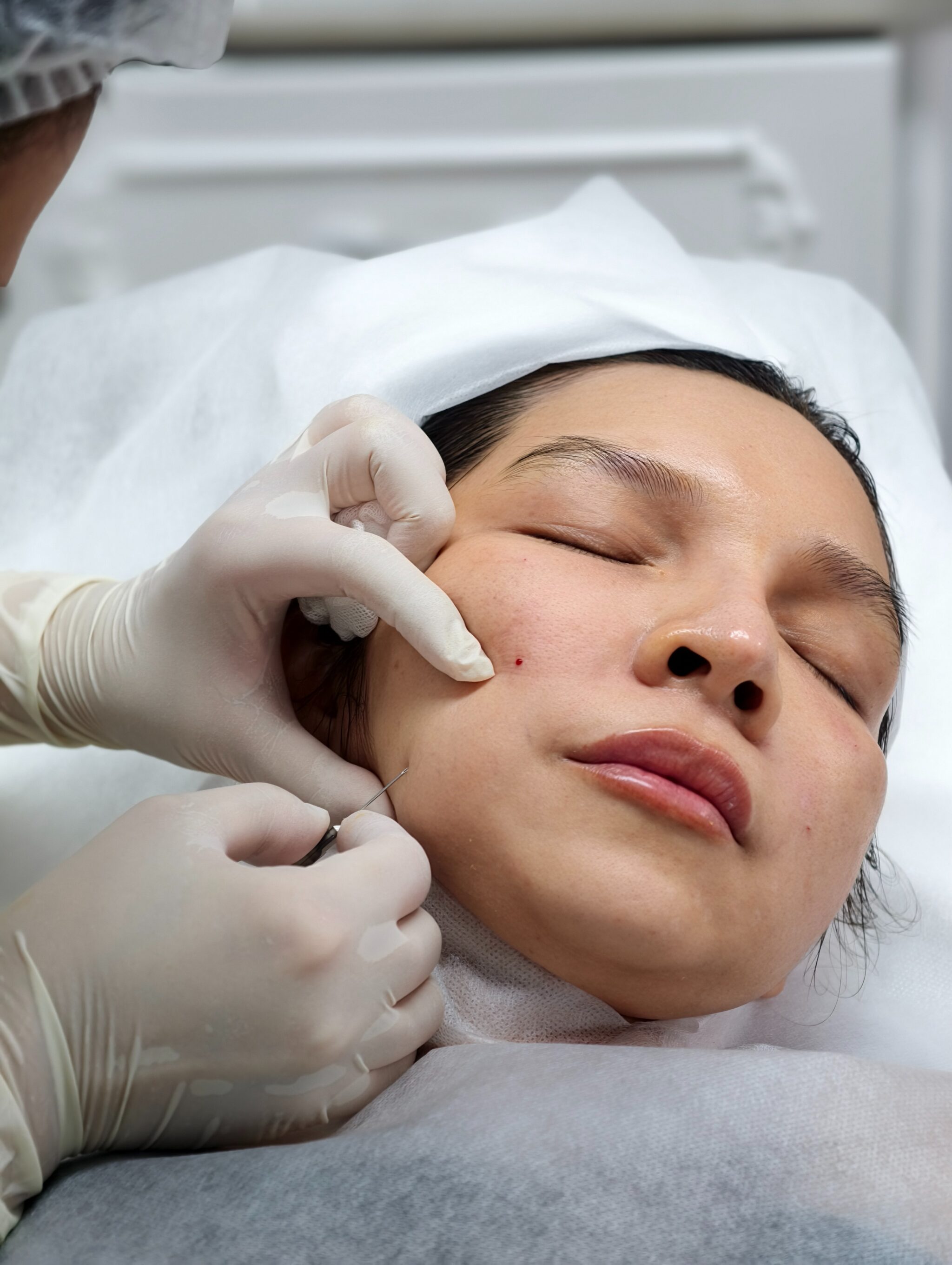 Quy trình Tiêm BAP tại Cần Thơ cùng Profilo và Jalupro