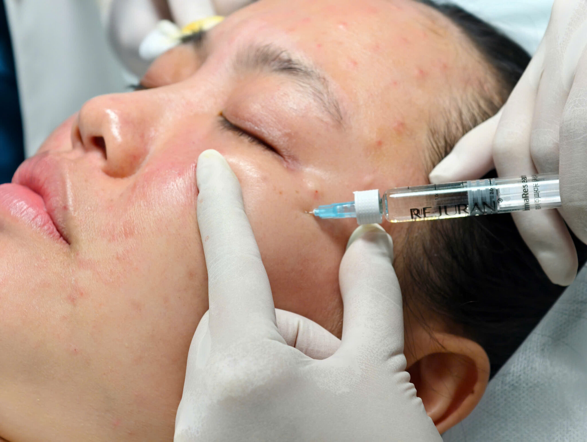 Phương pháp Tiêm BAP Rejuran Cần Thơ kết hợp HA và Rejuran