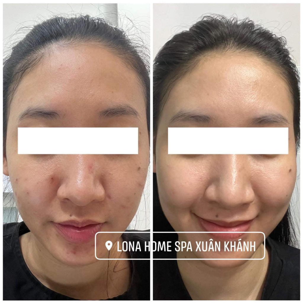 Ảnh minh họa điều trị da trẻ hóa tại Cần Thơ qua tiêm Meso và công nghệ HIFU, RF, Thermage, mang lại làn da trẻ trung.