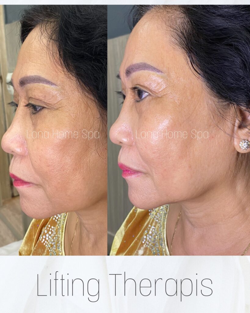 Quy trình sử dụng công nghệ HIFU, RF và Thermage kết hợp tiêm Meso, giúp trẻ hoá da tại Cần Thơ trở nên săn chắc và trẻ trung.