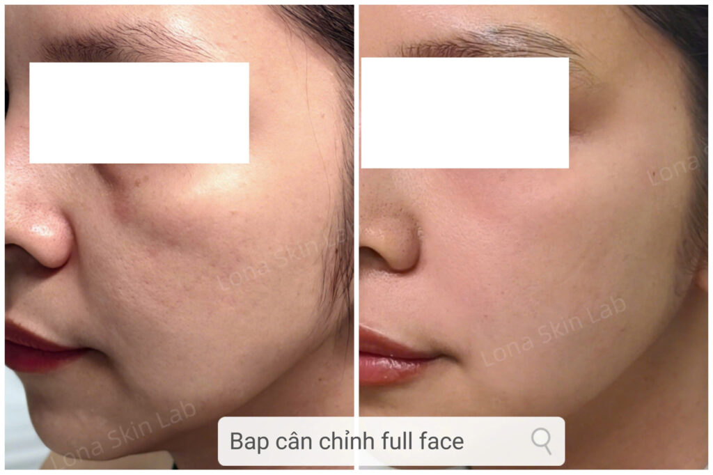 So sánh Meso và Bap, Tiêm Meso, Tiêm BAP, Sự khác biệt giữa Tiêm Meso và Tiêm BAP, Phương pháp trẻ hóa da, So sánh Tiêm Meso và Tiêm BAP, tiêm trẻ hóa da