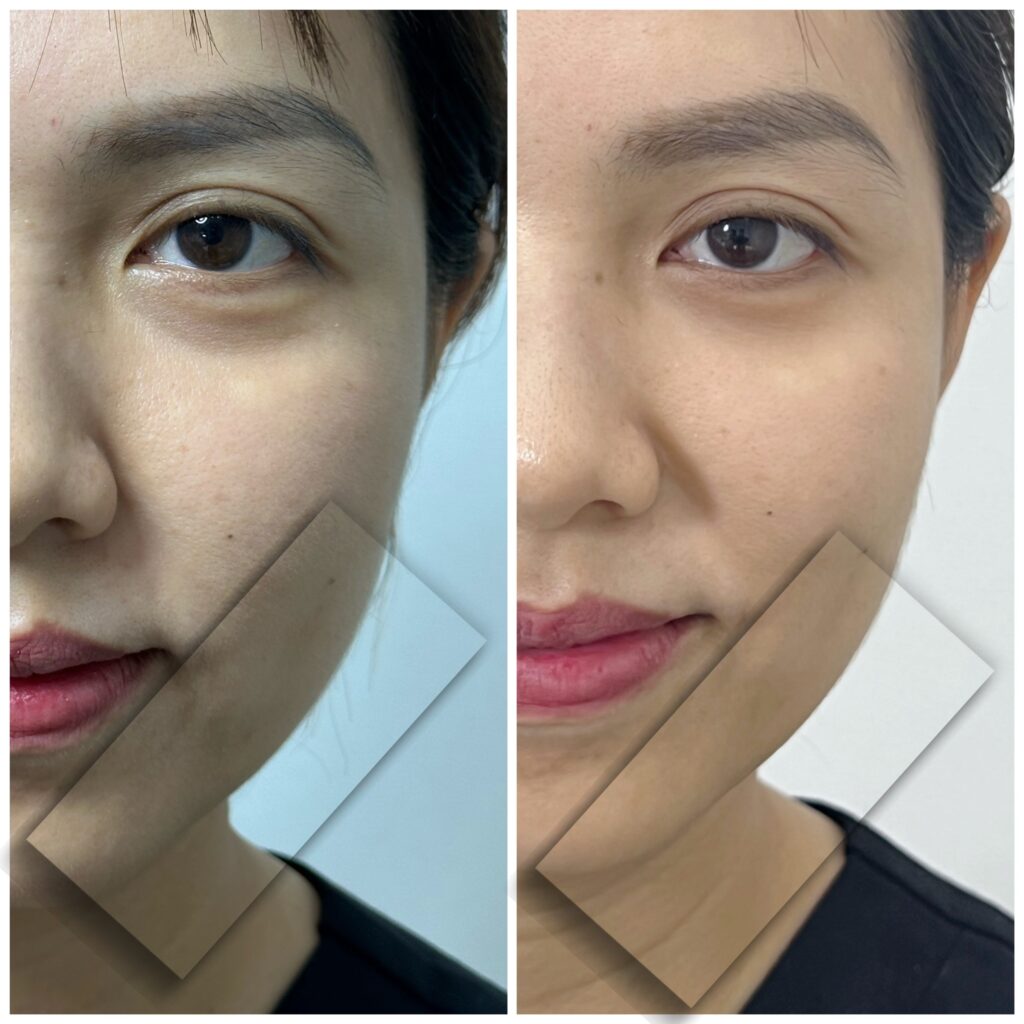 điều trị da đa tầng, điều trị da đa tầng, cấu trúc da, chất lượng mô, lão hóa da, tái tạo da