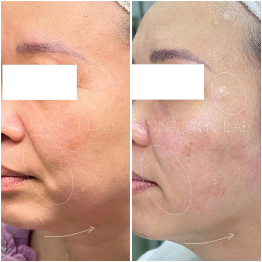 tăng collagen nội sinh, trẻ hóa da tự nhiên, collagen stimulator, lona.vn, filler