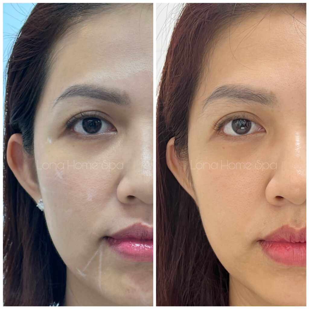 Hình ảnh so sánh trước và sau trị lão hóa đa tầng.