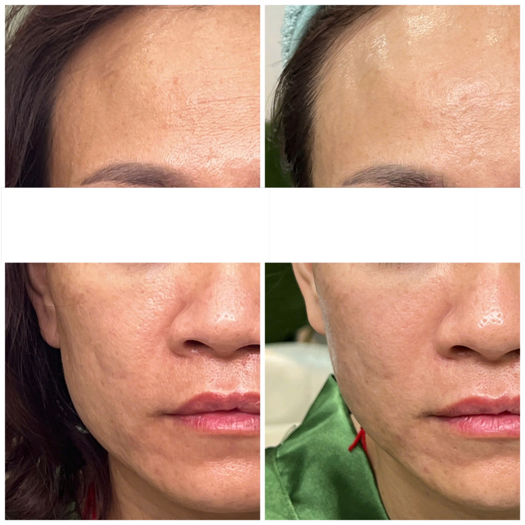 Hình ảnh trước sau minh họa hiệu quả của Tiêm Botox Vs Thermage trong cải thiện trẻ hóa da.