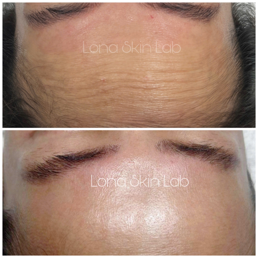 Qua hình ảnh trước và sau, sụp mí sau tiêm Botox được ghi nhận rõ ràng ở vùng trán, đồng thời nhấn mạnh tác dụng phụ của Botox trong điều trị thẩm mỹ, từ đó góp phần cảnh báo về biến chứng Botox trán.