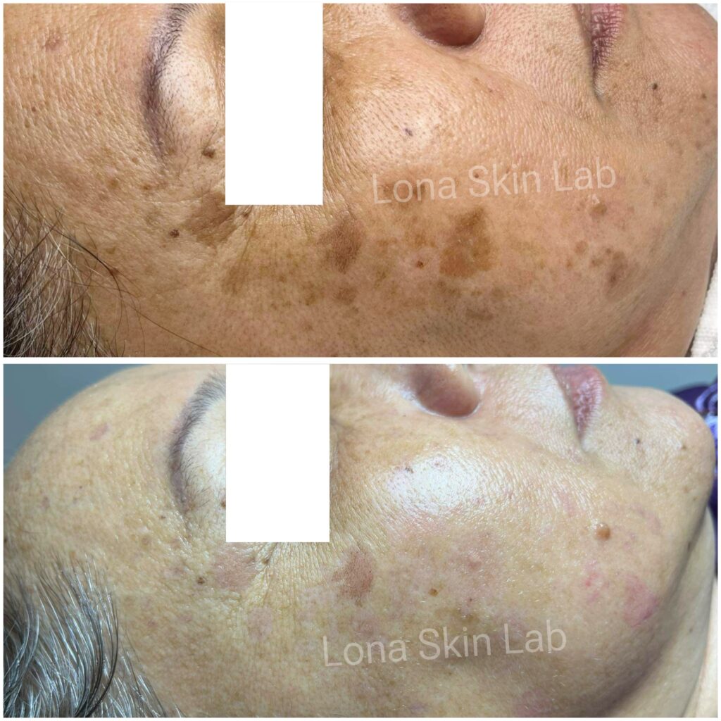 trị rạn da trắng - Hình ảnh before & after điều trị laser