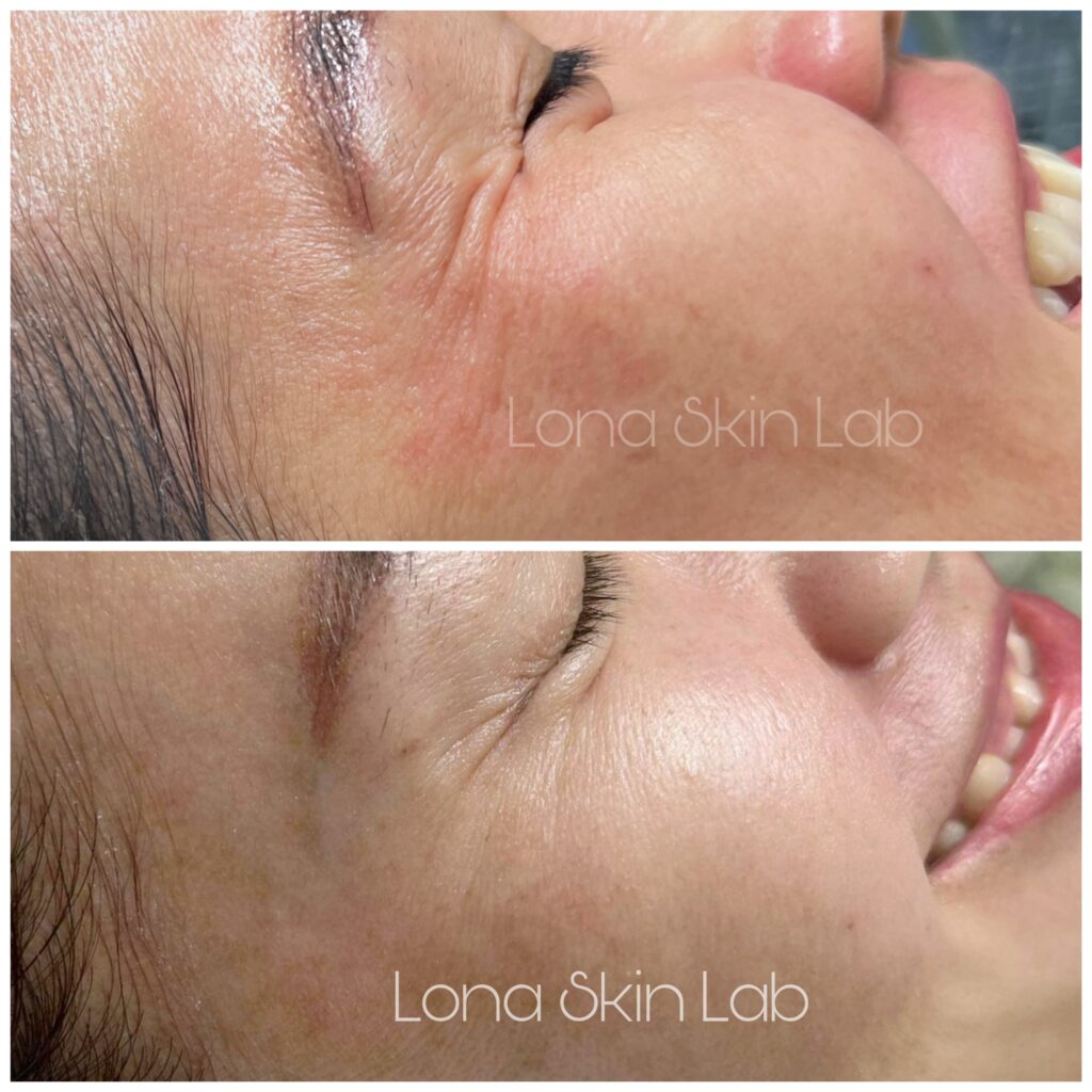 Hình ảnh minh họa cho biến chứng botox vùng mắt; botox mắt, tiêm botox, xử lý biến chứng botox, phòng ngừa botox