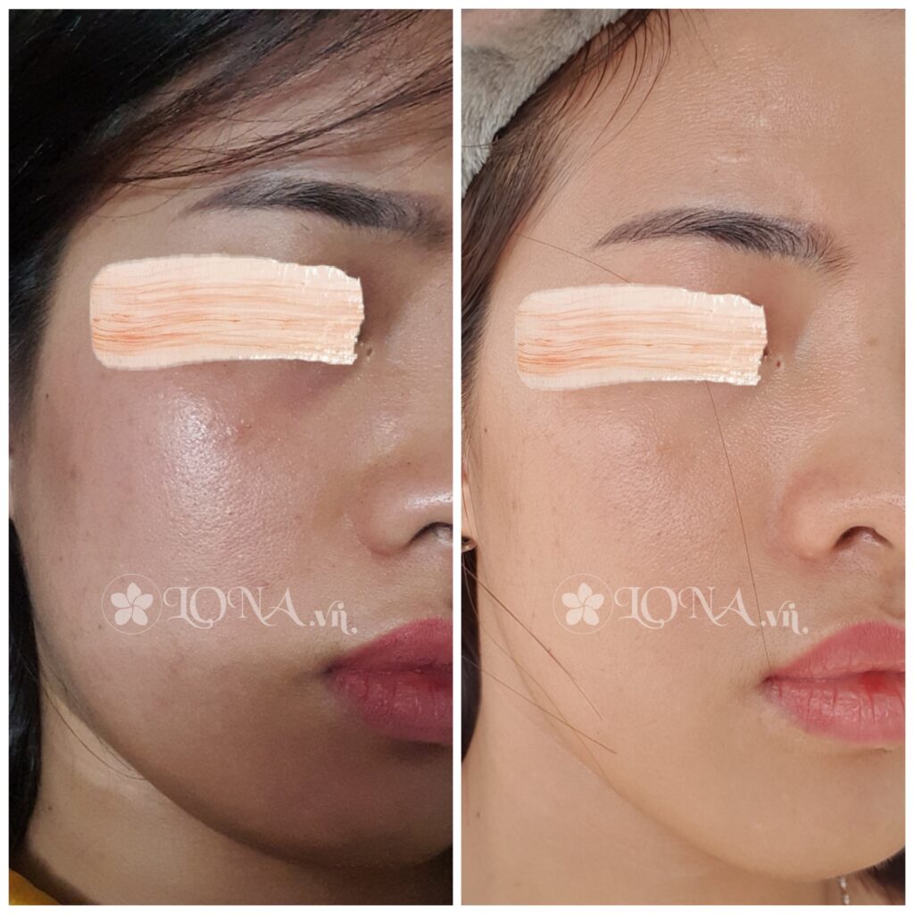 Quy trình điều trị da trẻ hóa tại Cần Thơ kết hợp tiêm Meso và công nghệ RF, HIFU, Thermage để kích thích collagen và tái tạo da.