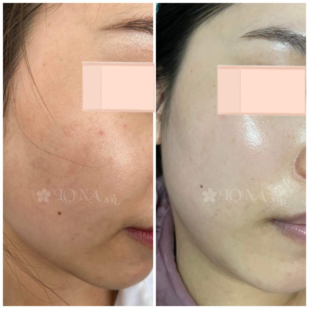 Điều trị rụng tóc, rụng tóc, điều trị rụng tóc, viêm mô nền, nội tiết vi tuần hoàn, exosome
