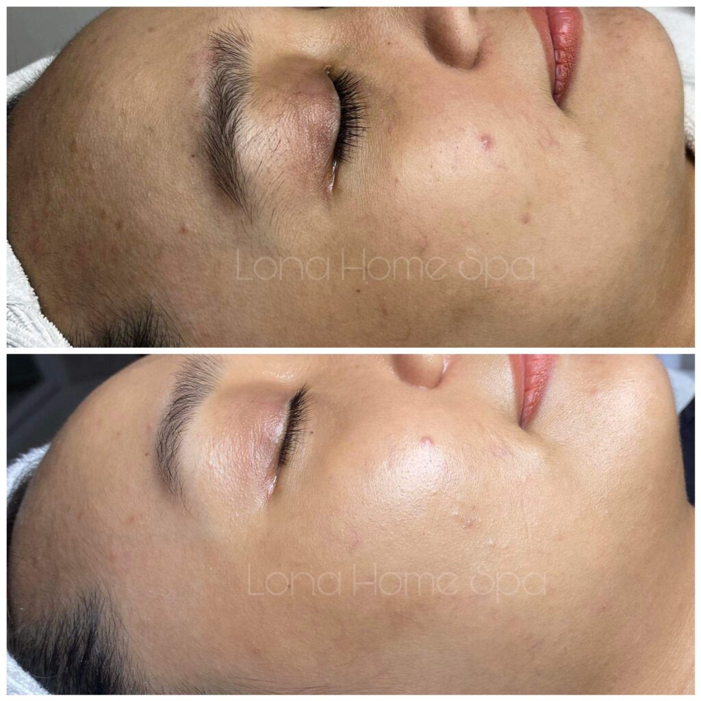 Điều trị rụng tóc, rụng tóc, điều trị rụng tóc, viêm mô nền, nội tiết vi tuần hoàn, exosome
