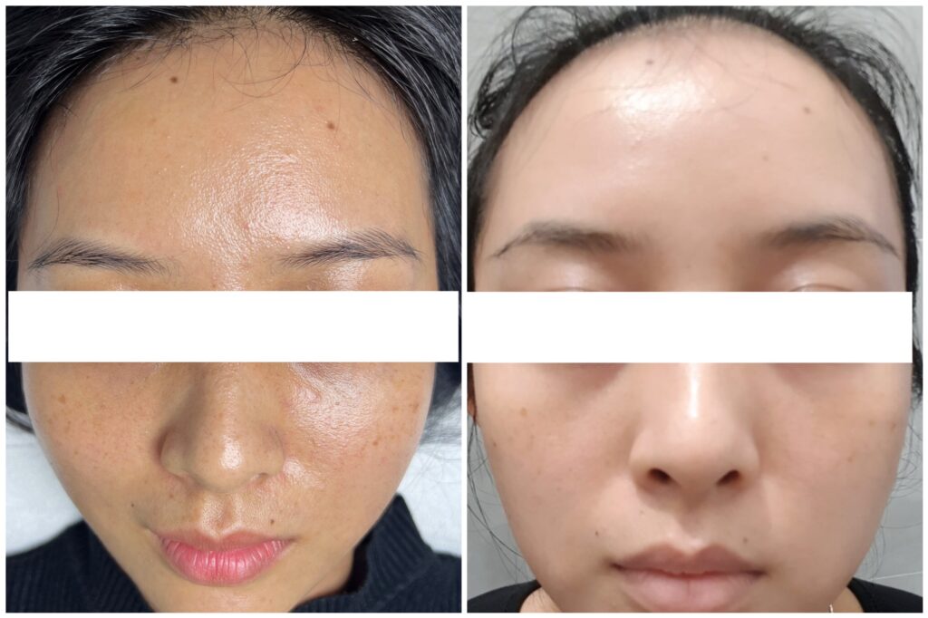 Điều trị rụng tóc, rụng tóc, điều trị rụng tóc, viêm mô nền, nội tiết vi tuần hoàn, exosome