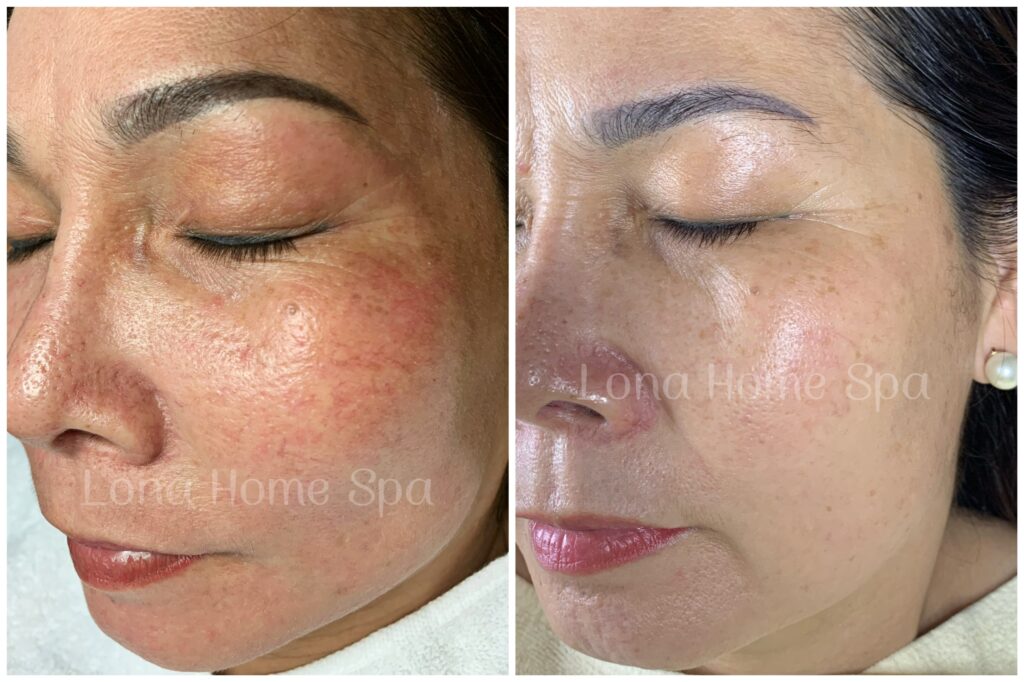 Điều trị rụng tóc, rụng tóc, điều trị rụng tóc, viêm mô nền, nội tiết vi tuần hoàn, exosome