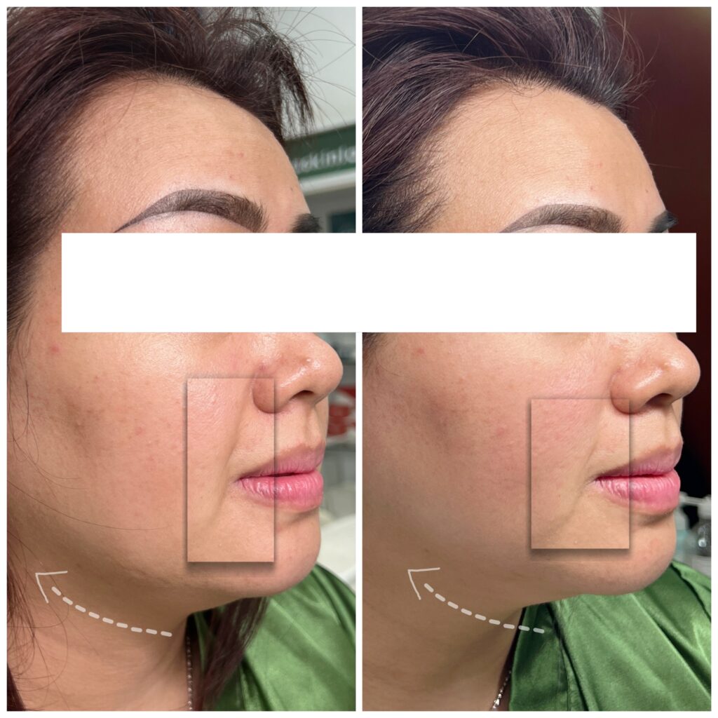 Hình ảnh trước và sau cho thấy sự cải thiện rõ rệt trong quá trình phục hồi da sau thủ thuật xâm lấn, với định hướng chu kỳ mô trong phục hồi da và chăm sóc da sau phẫu thuật thẩm mỹ.