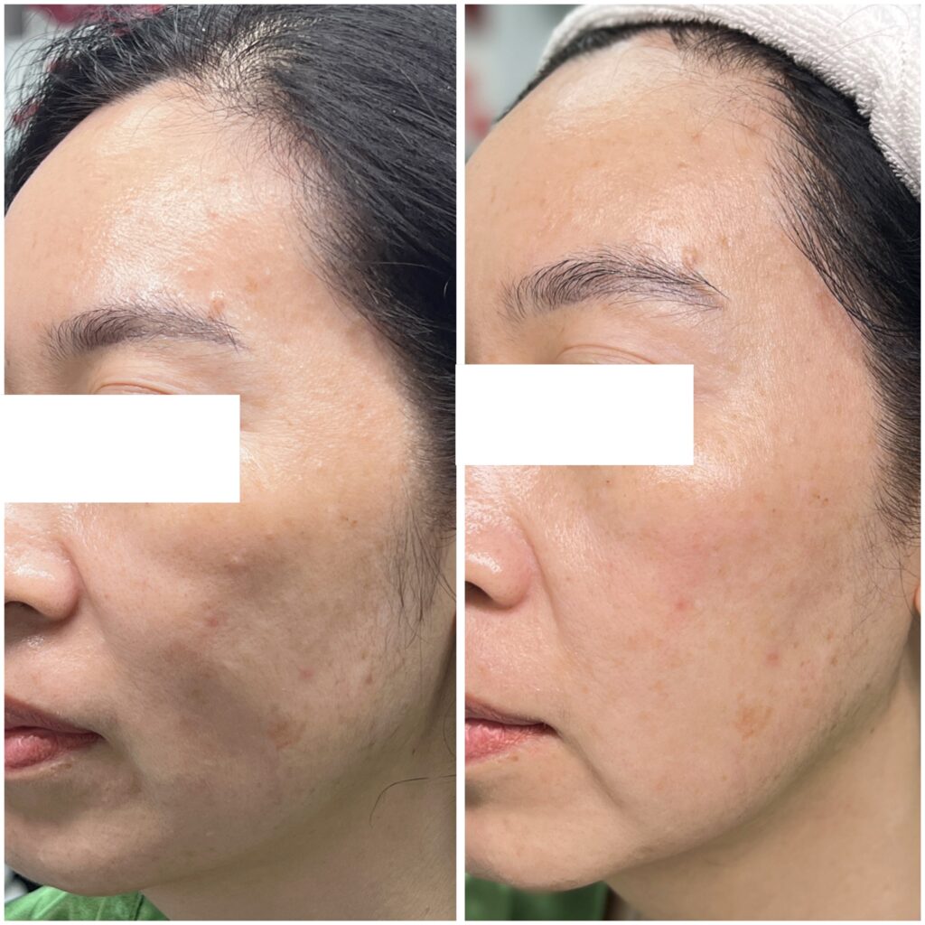 Hình ảnh minh họa quá trình phục hồi da sau thủ thuật xâm lấn với sự chăm sóc da sau phẫu thuật thẩm mỹ được thực hiện kỹ lưỡng, khuyến khích tái tạo da sau can thiệp xâm lấn qua định hướng chu kỳ mô trong phục hồi da và quá trình lành vết thương da hiệu quả.