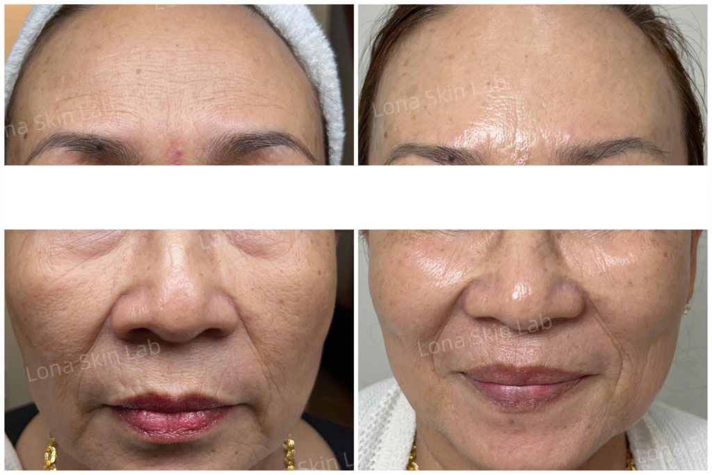 Kết hợp mạnh mẽ giữa tiêm Meso và công nghệ HIFU, RF cùng Thermage, quy trình này tối ưu trẻ hoá da tại Cần Thơ.