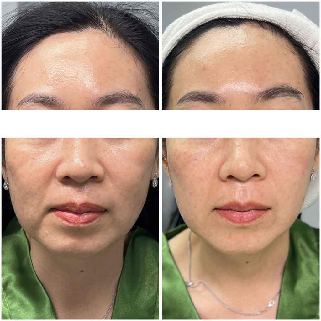 Hình ảnh before-after minh họa liệu trình điều trị da thực tế, chăm sóc da và làm đẹp