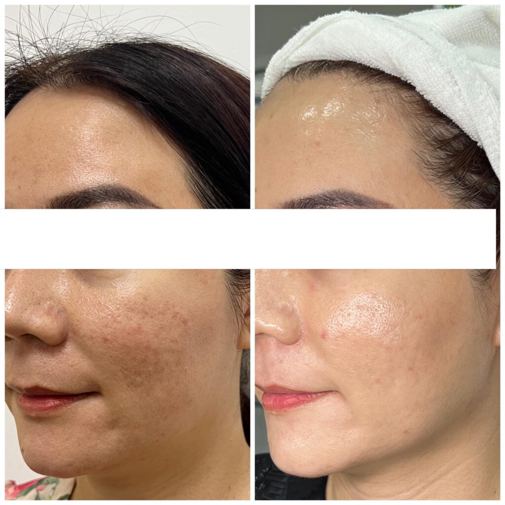 Hình ảnh kết quả trị liệu kết hợp với điều trị da và công nghệ thẩm mỹ đạt hiệu quả cao