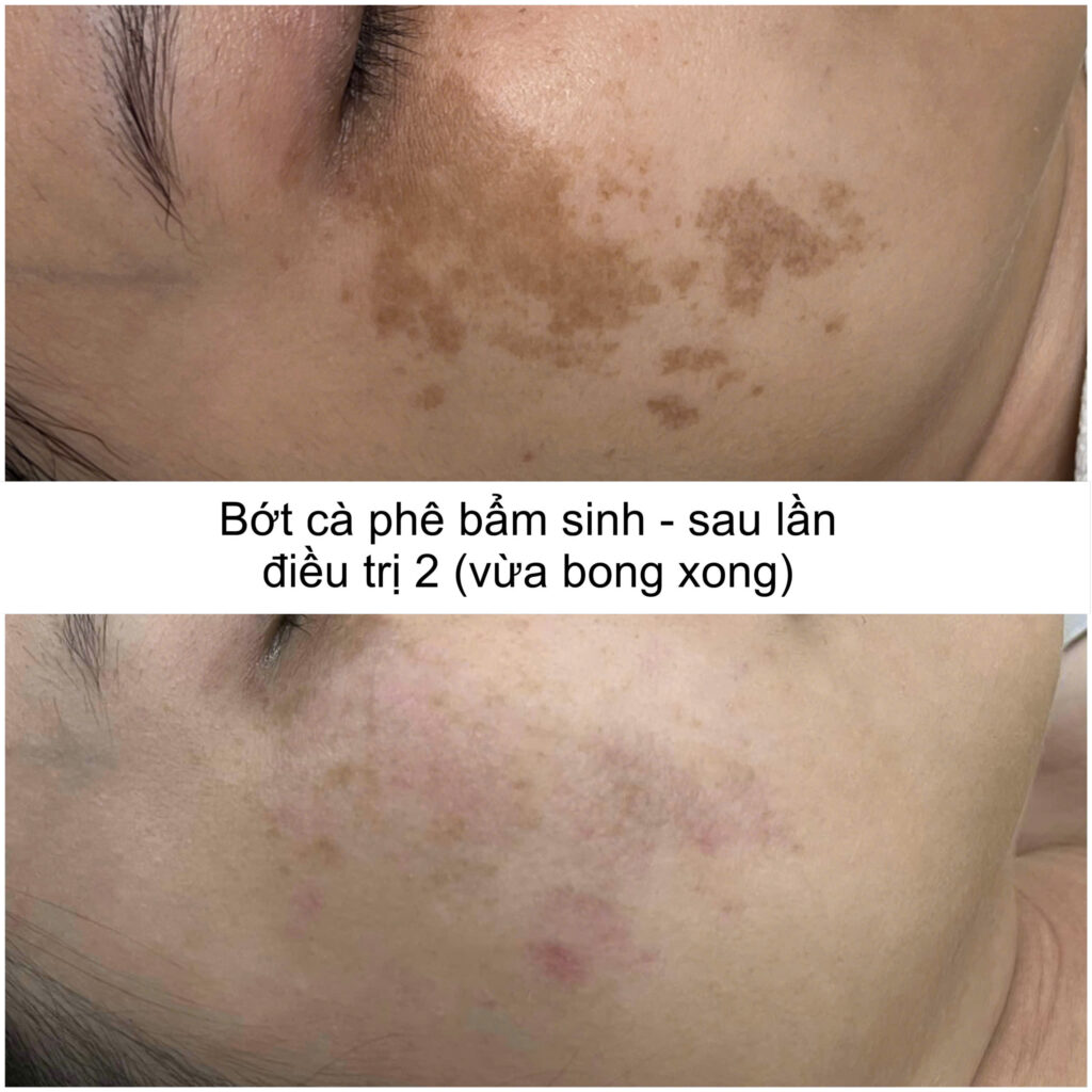 Trong mô hình xử lý khiếm khuyết sau mụn, chuyên gia hướng tới phục hồi da sau mụn một cách toàn diện, quản lý hậu mụn và áp dụng công nghệ trị sẹo mụn tiên tiến để tái cấu trúc da hiệu quả.