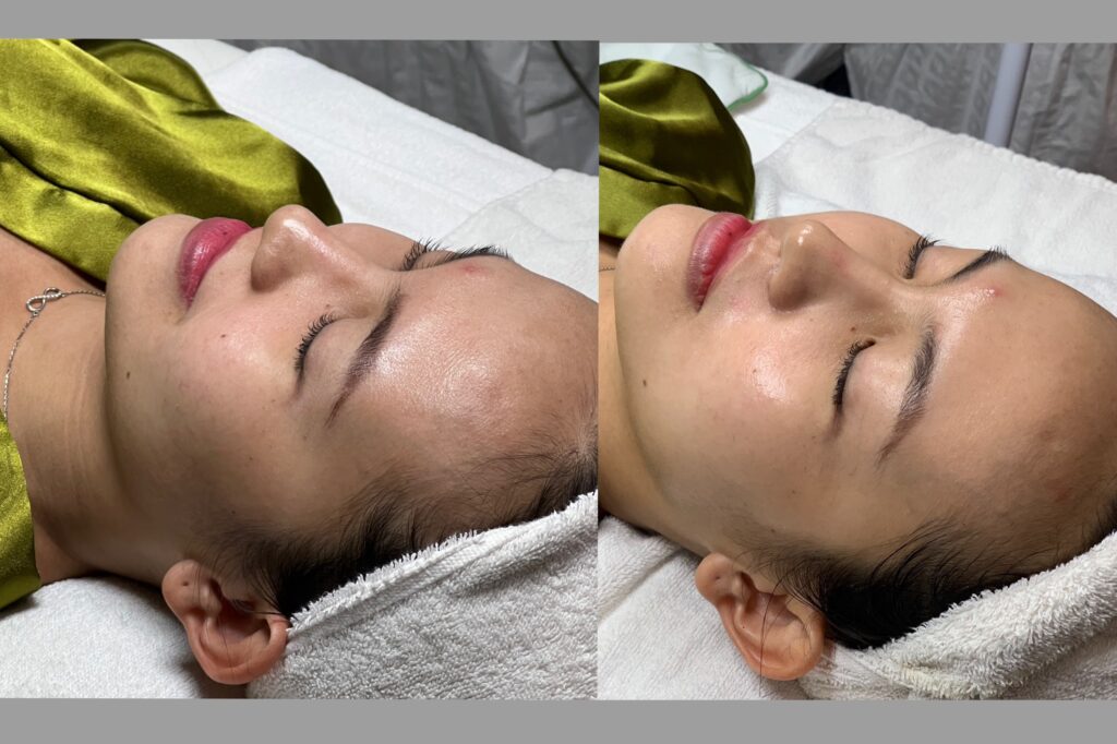 Before and after laser không hiệu quả được cải thiện nhờ chiến lược từ Lona Skin Lab