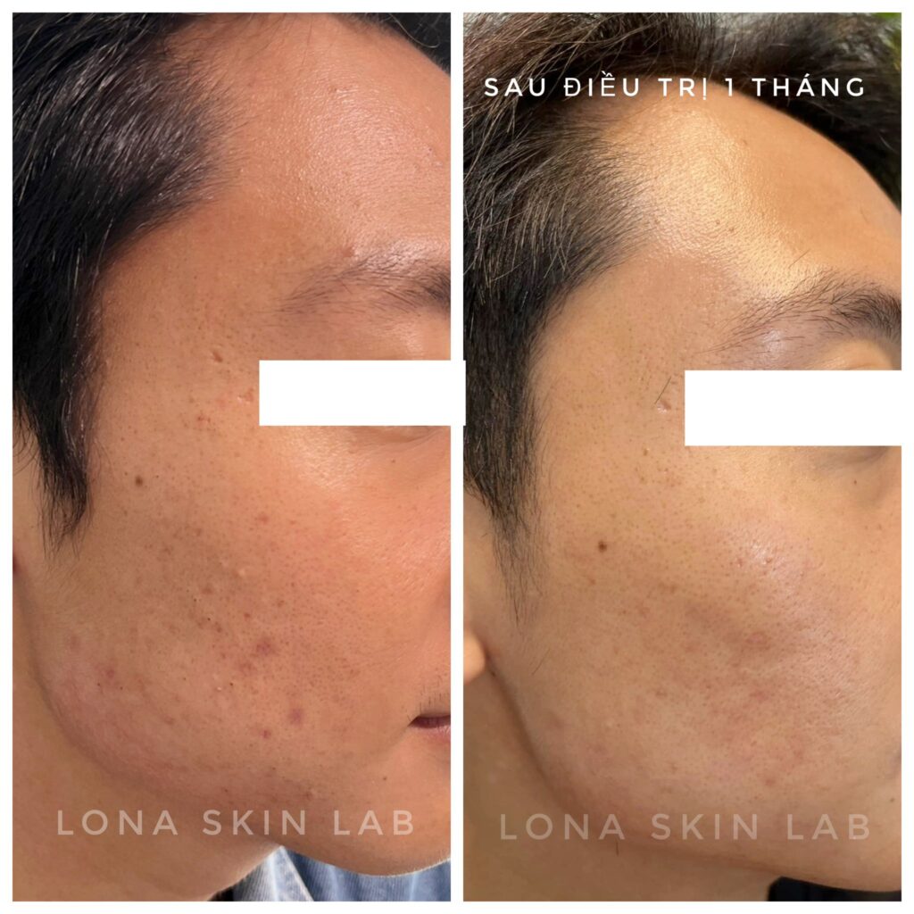 Việc xử lý khiếm khuyết sau mụn được triển khai qua các bước can thiệp nhằm phục hồi da sau mụn, quản lý hậu mụn và đem lại hiệu quả trị sẹo mụn, qua đó giúp tái cấu trúc da một cách bền vững.