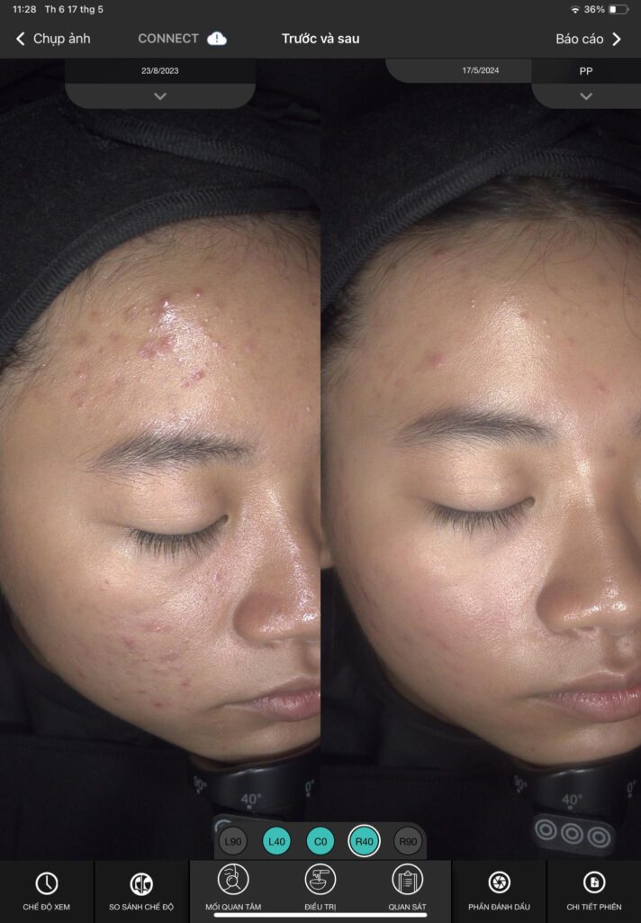 Qua hình ảnh, chúng ta nhận thấy tác động của liệu trình chăm sóc da mụn ẩn hiệu quả, khi cách trị mụn ẩn tiên tiến được triển khai nhằm giảm mụn ẩn và mụn ẩn dai dẳng, khắc phục nguyên nhân mụn ẩn.