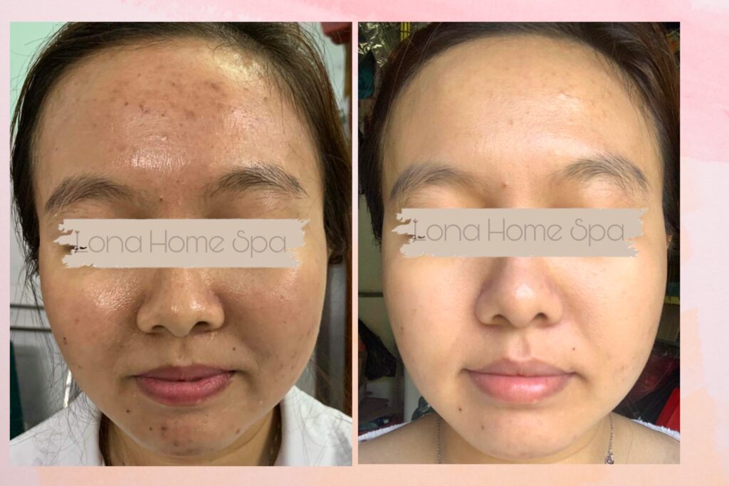 Ảnh minh họa cho quy trình điều trị mụn ẩn chu đáo, trong đó cách trị mụn ẩn được thực hiện theo chuẩn mực da liễu để giải quyết mụn ẩn dai dẳng và nhận diện nguyên nhân mụn ẩn, qua đó cải thiện chăm sóc da mụn ẩn.
