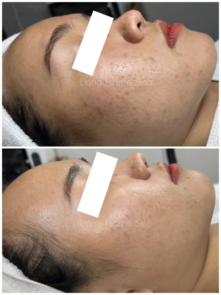 Quá trình điều trị mụn viêm và phòng sẹo mụn theo triết lý sẹo mụn phòng dễ hơn trị tại Lona Skin Lab