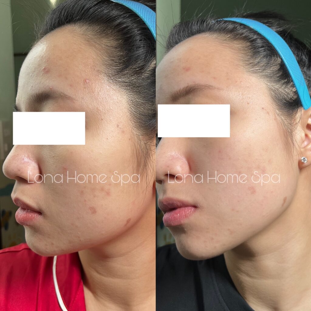 Hình ảnh này phản ánh quá trình chăm sóc da mụn ẩn thông qua các biện pháp cách trị mụn ẩn an toàn, giúp làm dịu mụn ẩn dai dẳng và điều chỉnh nguyên nhân mụn ẩn, mang lại hiệu quả điều trị mụn ẩn rõ rệt.