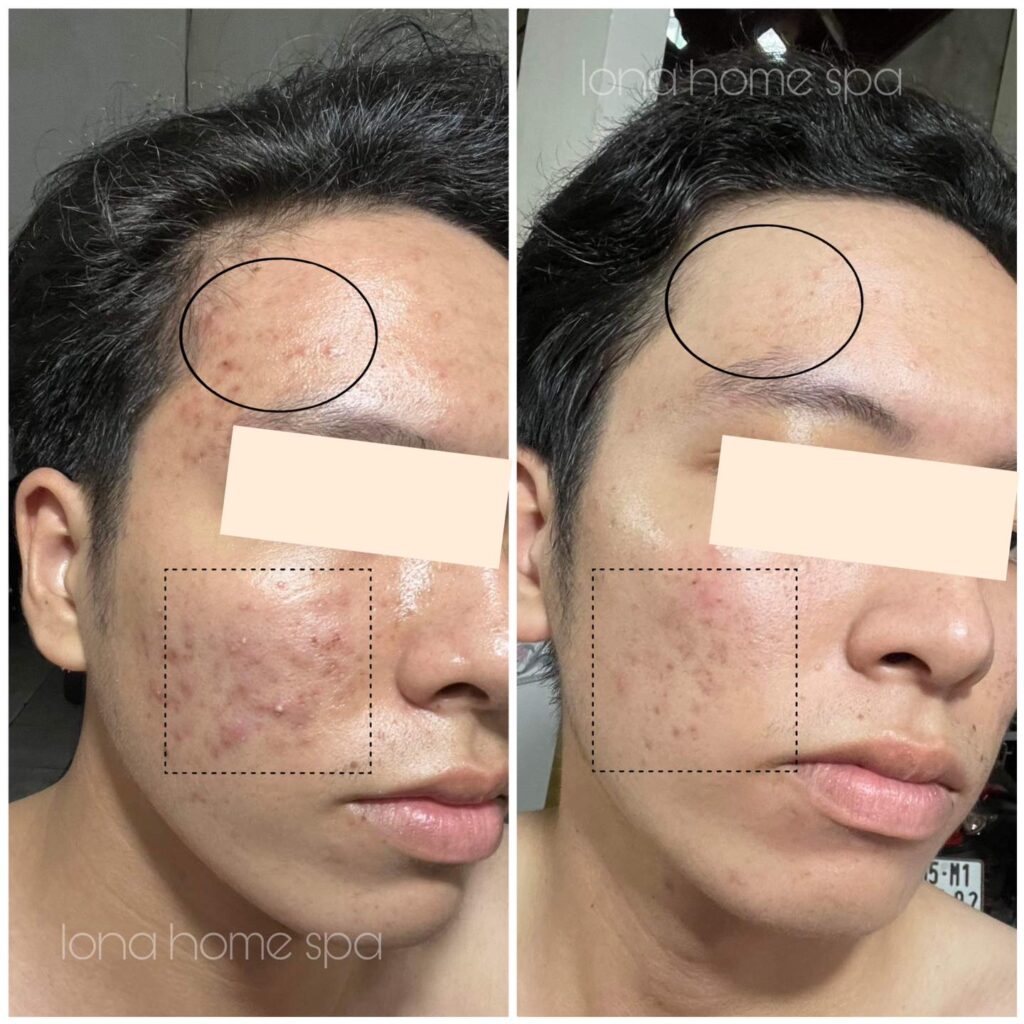 Ảnh này cho thấy quy trình chăm sóc da mụn ẩn được áp dụng cẩn trọng, với cách trị mụn ẩn chuyên sâu giúp hạn chế mụn ẩn và mụn ẩn dai dẳng, đồng thời làm sáng tỏ các nguyên nhân mụn ẩn.