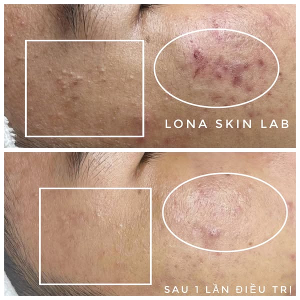 Lona cam kết xử lý mụn tuổi dậy thì đúng cách