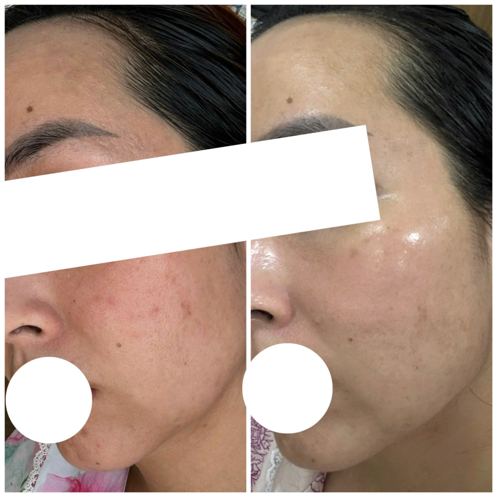 Ảnh minh họa giải pháp trị nám da theo liệu trình trị liệu đa phương pháp của chuyên gia Lona, giúp nhận diện các nguyên nhân nám da và phòng ngừa nám da hiệu quả