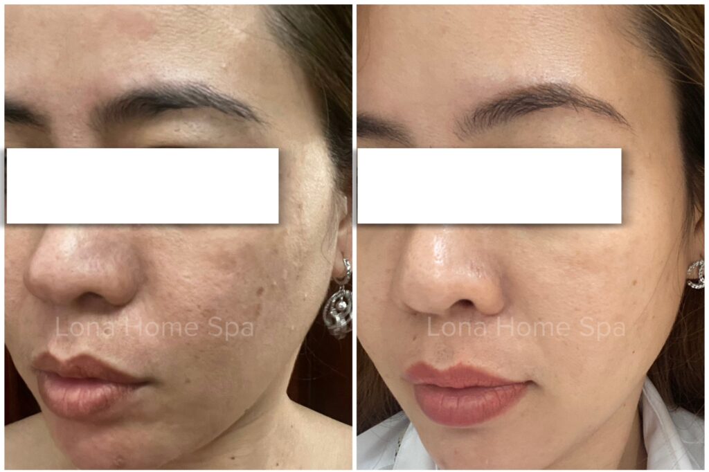 Hình ảnh trước và sau khi điều trị nám da bằng laser, giúp làm mờ vết nám và phòng ngừa nám da hiệu quả