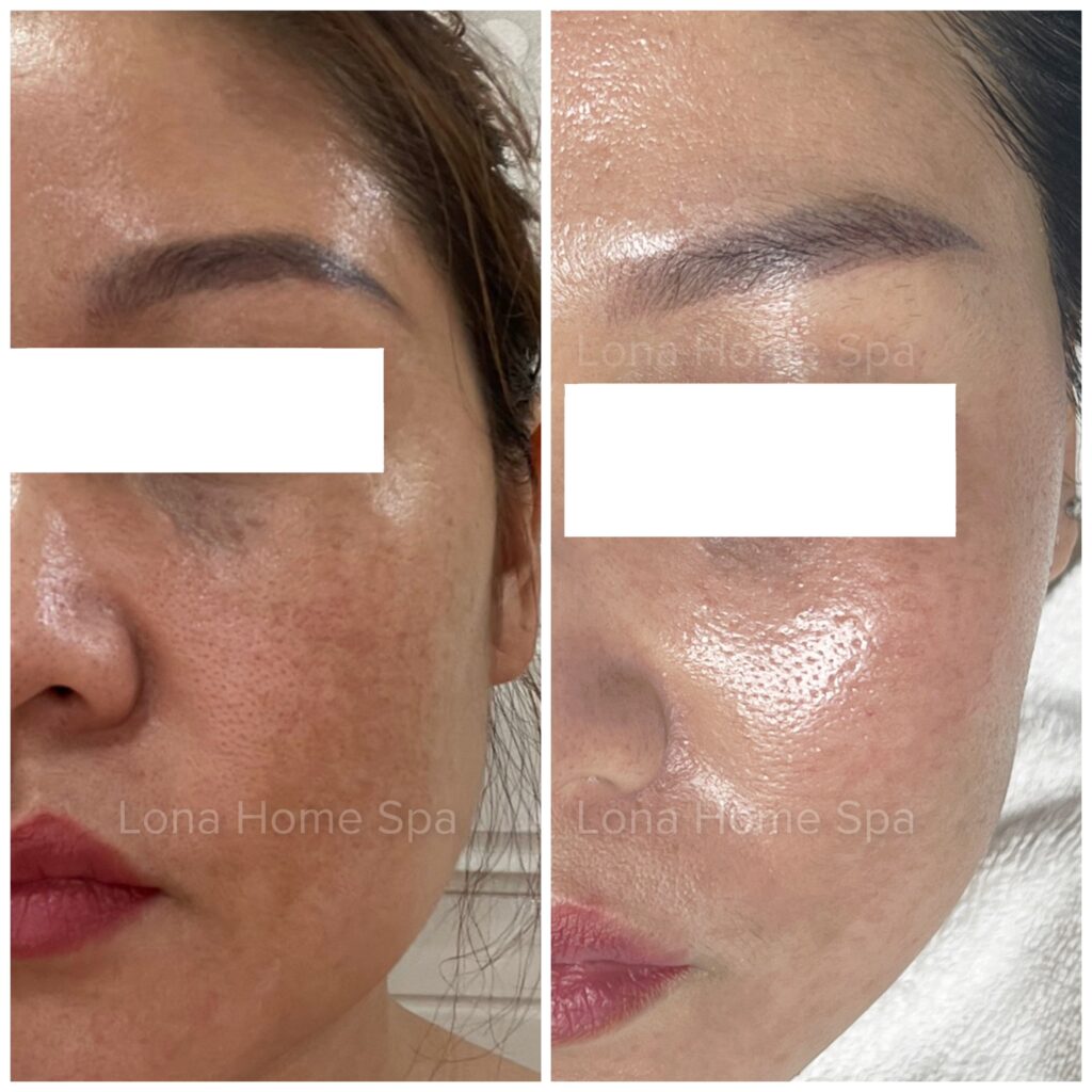 Minh họa các phương pháp trị liệu đa phương pháp trong điều trị nám da giúp kiểm soát sắc tố và phòng ngừa nám da - kem trị nám