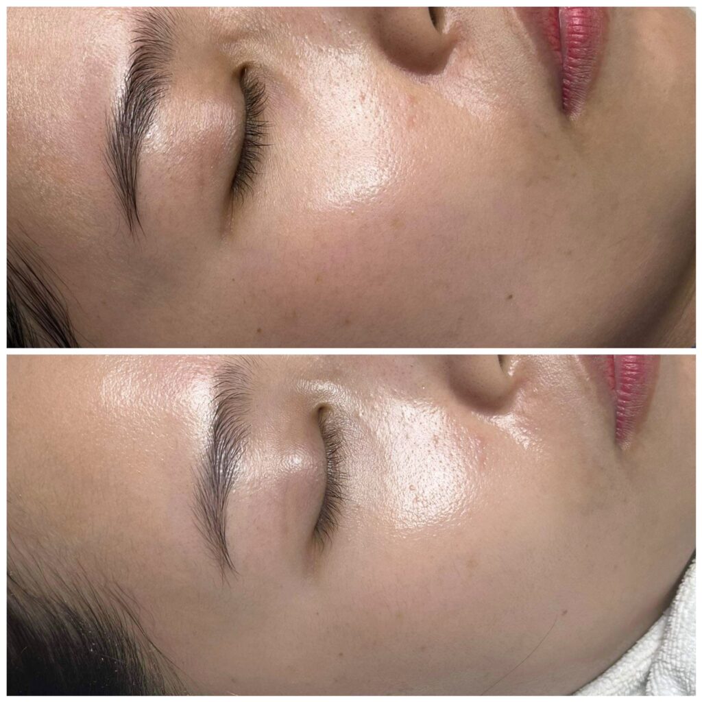 Hình ảnh minh họa cho peel da trị sẹo rỗ khi áp dụng quá trình peel da trị sẹo rỗ kết hợp với cách tái tạo làn da hiệu quả qua phương pháp peel da, đồng thời nhấn mạnh chăm sóc da sau peel và ưu nhược điểm của peel da trong điều trị sẹo rỗ.