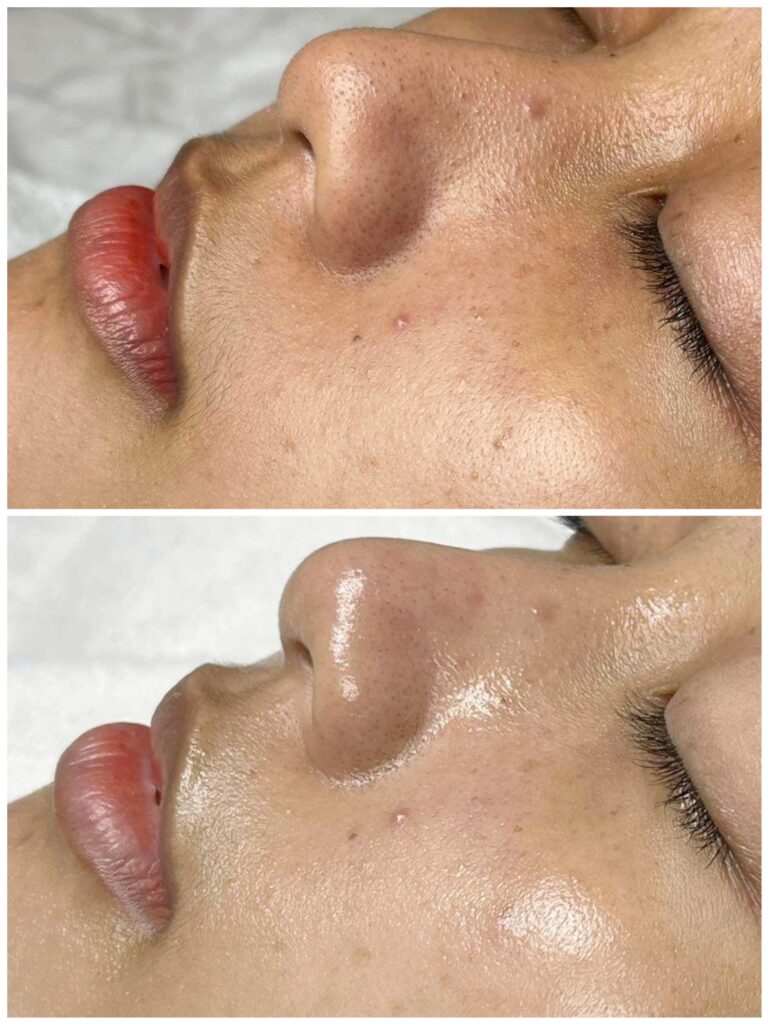 Ảnh cho thấy kỹ thuật peel da trị sẹo rỗ tiến hành theo cách tái tạo làn da hiệu quả, sử dụng phương pháp peel da hiện đại, kèm theo các lưu ý về chăm sóc da sau peel để khắc phục ưu nhược điểm của peel da.