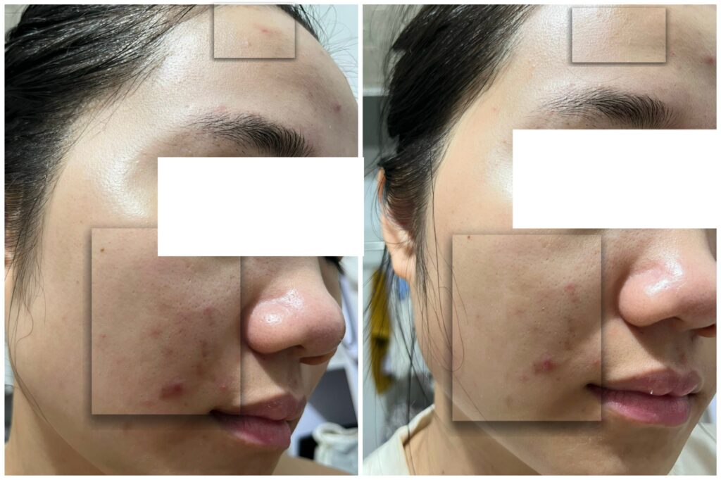 Hình ảnh khẳng định hiệu quả của peel da trị sẹo rỗ với cách tái tạo làn da hiệu quả, đồng thời nhấn mạnh chăm sóc da sau peel trong điều trị sẹo rỗ.