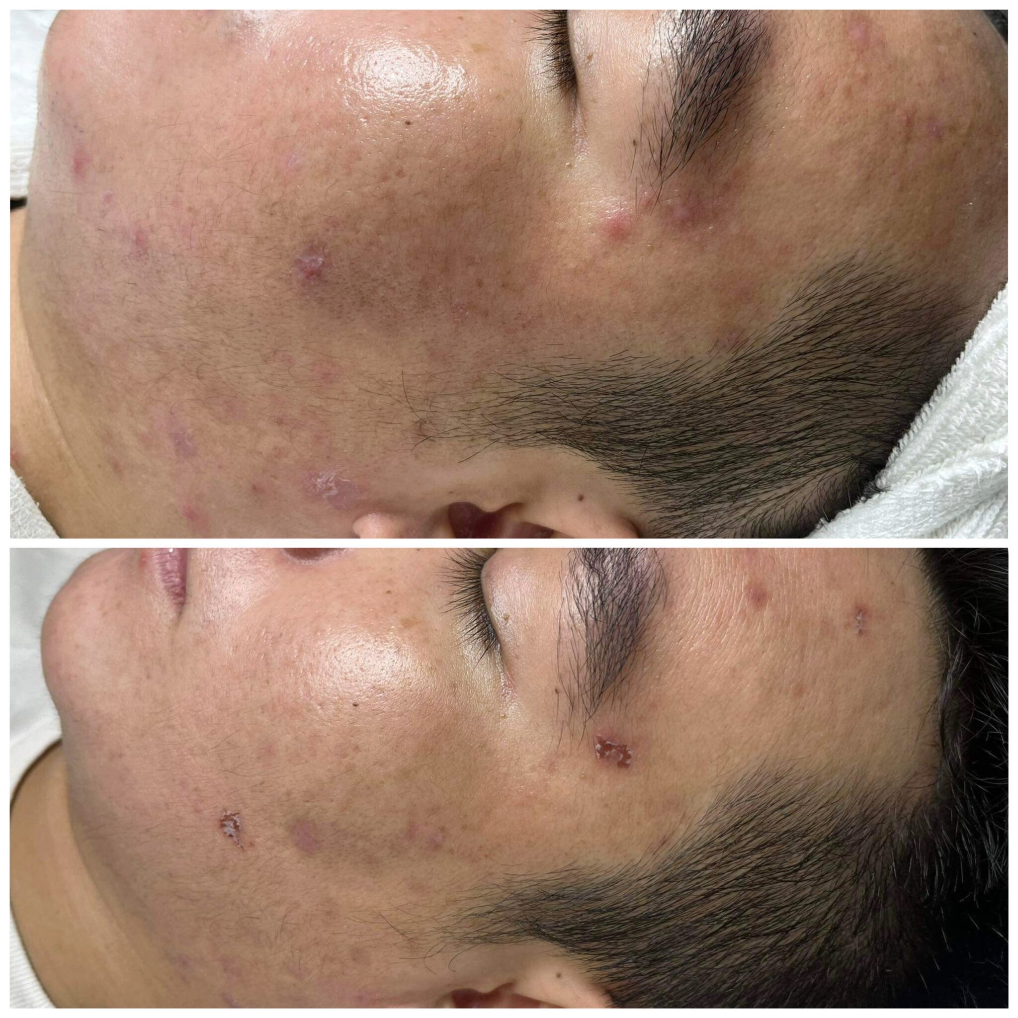 Điều trị giãn mao mạch tại Cần Thơ - Trước và sau điều trị
