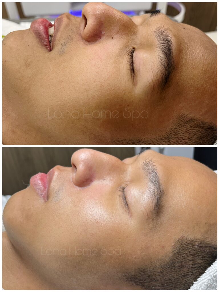 Sự thay đổi rõ nét của peel da trị sẹo rỗ khi áp dụng cách tái tạo làn da hiệu quả, đồng thời quản lý ưu nhược điểm của peel da.