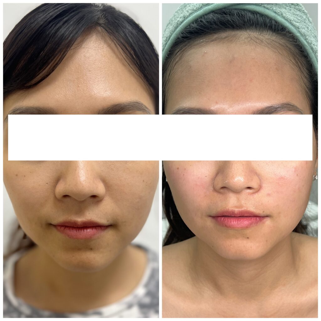 Biến chứng Botox vùng mắt giúp nhận diện rủi ro và giải pháp xử lý, botox mắt, tiêm botox, phòng ngừa botox