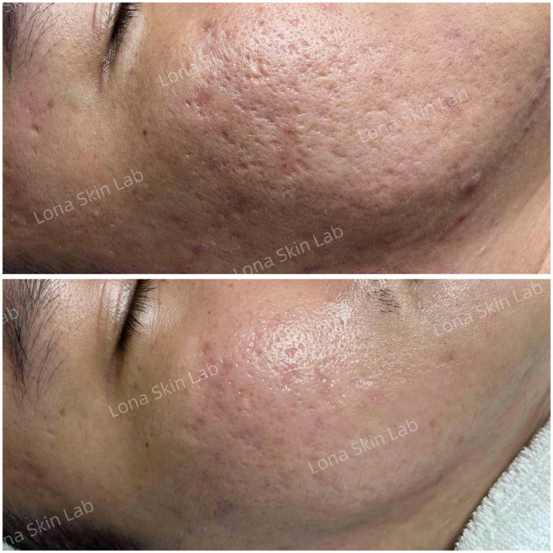 Hình ảnh trước và sau điều trị minh họa triệu chứng giãn mao mạch, giúp đánh giá hiệu quả quy trình điều trị giãn mao mạch ở mặt.