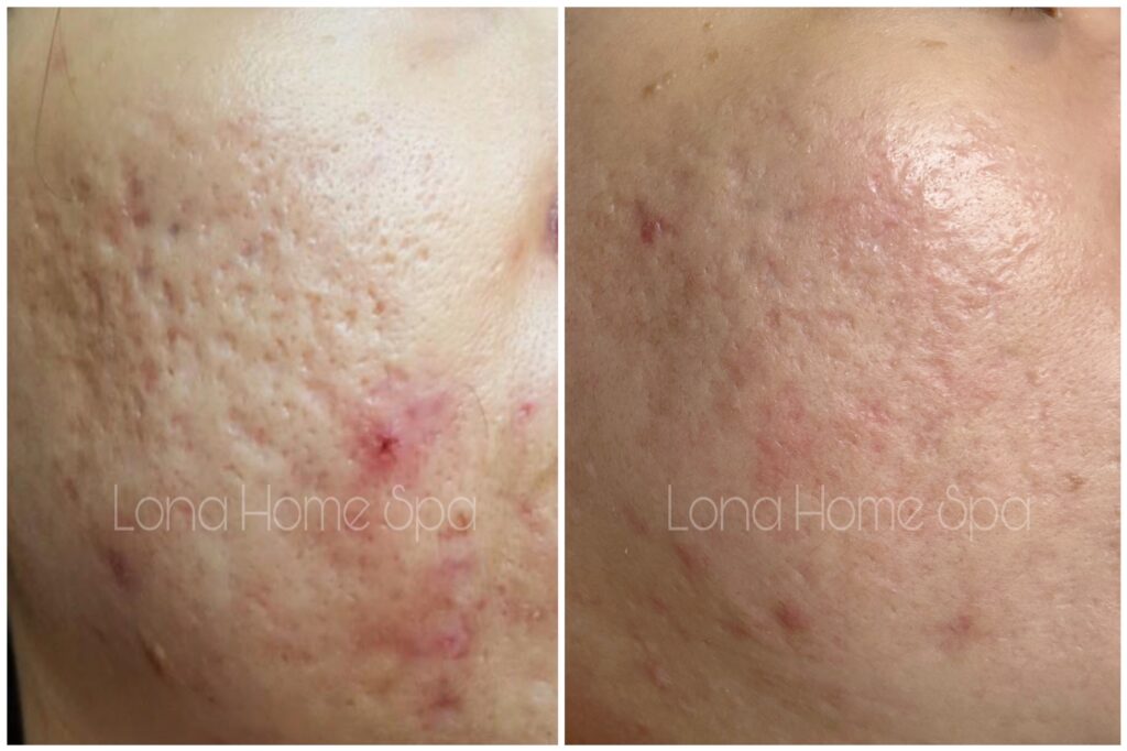 lỗ chân lông to và sẹo chân đinh, lỗ chân lông to, sẹo chân đinh, điều trị da, Lona Skin Lab